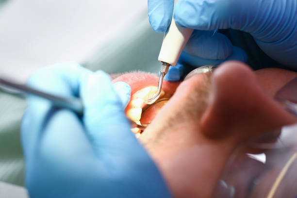 Best Emergency Tooth Extraction in Hennessey, OK