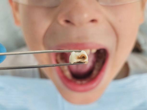 Best Emergency Tooth Extraction in Hennessey, OK