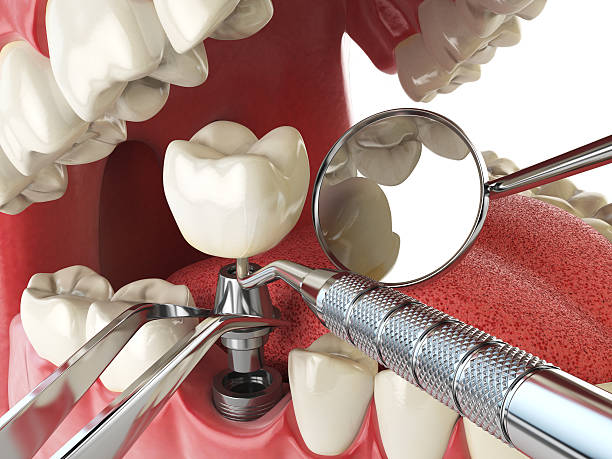 Best Emergency Tooth Extraction in Hennessey, OK